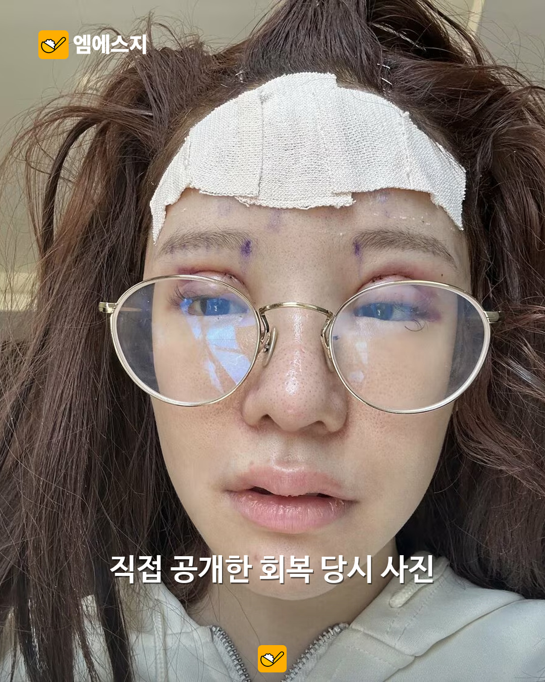 “성형만 25번 이상” 히라세 아이리, 과거 얼굴·회복 사진 직접 공개한 인터뷰 재조명 3 당사자가 인터뷰에서 직접 공개한 당시 회복 사진